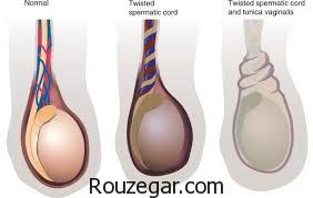 نازایی در مردان چیست،علت نازایی در مردان،درمان گیاهی نازایی در مردان