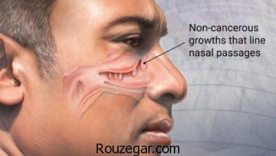 درمان پولیپ بینی،عوارض جراحی پولیپ بینی،علائم پولیپ بینی