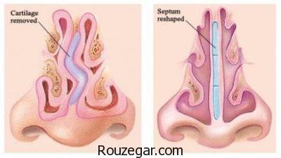درمان پولیپ بینی،عوارض جراحی پولیپ بینی،علائم پولیپ بینی
