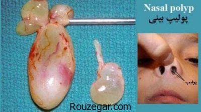 درمان پولیپ بینی،عوارض جراحی پولیپ بینی،علائم پولیپ بینی