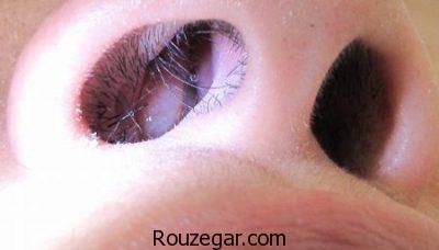 درمان پولیپ بینی،عوارض جراحی پولیپ بینی،علائم پولیپ بینی