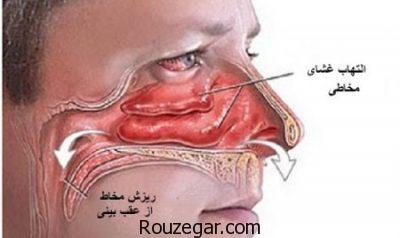 درمان پولیپ بینی،عوارض جراحی پولیپ بینی،علائم پولیپ بینی