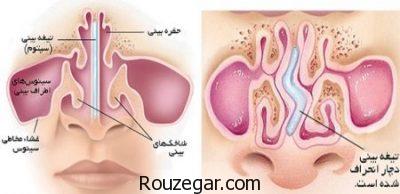 درمان پولیپ بینی،عوارض جراحی پولیپ بینی،علائم پولیپ بینی