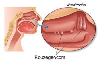 درمان پولیپ بینی،عوارض جراحی پولیپ بینی،علائم پولیپ بینی