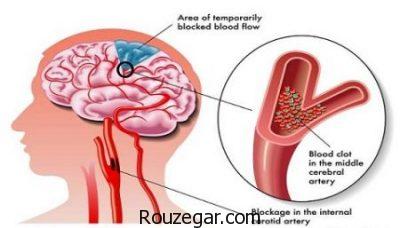 علائم سکته مغزی در خواب،جلوگیری از سکته مغزی،درمان خانگی سکته مغزی