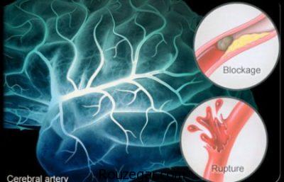 علائم سکته مغزی در خواب،جلوگیری از سکته مغزی،درمان خانگی سکته مغزی
