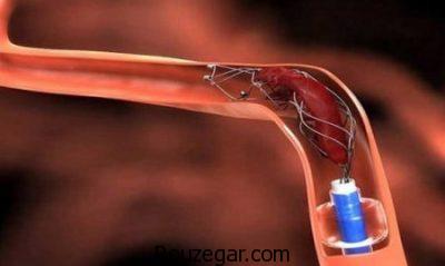 علائم سکته مغزی در خواب،جلوگیری از سکته مغزی،درمان خانگی سکته مغزی