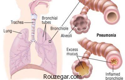 درمان قطعی ذات الریه،درمان طب سنتی ذات الریه،داروی گیاهی برای ذات الریه
