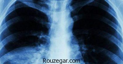 درمان قطعی ذات الریه،درمان طب سنتی ذات الریه،داروی گیاهی برای ذات الریه