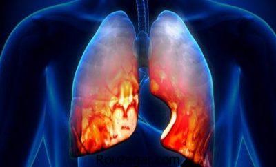 درمان قطعی ذات الریه،درمان طب سنتی ذات الریه،داروی گیاهی برای ذات الریه