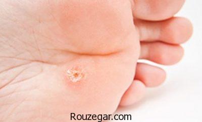 درمان زگیل کف پا در طب سنتی،درمان زگیل کف پا با سرکه،درمان زگیل کف پا با لیزر