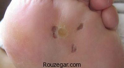 درمان زگیل کف پا در طب سنتی،درمان زگیل کف پا با سرکه،درمان زگیل کف پا با لیزر