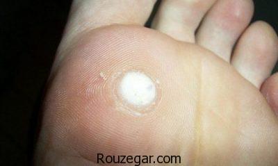 درمان زگیل کف پا در طب سنتی،درمان زگیل کف پا با سرکه،درمان زگیل کف پا با لیزر