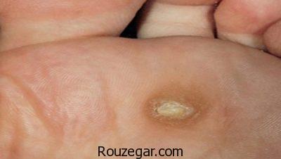 درمان زگیل کف پا در طب سنتی،درمان زگیل کف پا با سرکه،درمان زگیل کف پا با لیزر