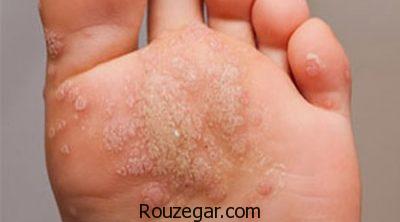 درمان زگیل کف پا در طب سنتی،درمان زگیل کف پا با سرکه،درمان زگیل کف پا با لیزر