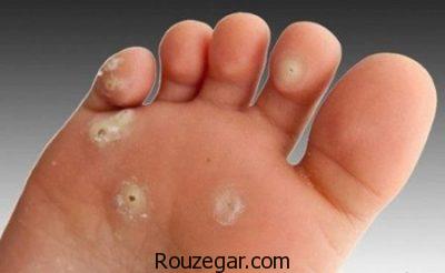 درمان زگیل کف پا در طب سنتی،درمان زگیل کف پا با سرکه،درمان زگیل کف پا با لیزر