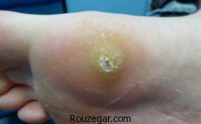 درمان زگیل کف پا در طب سنتی،درمان زگیل کف پا با سرکه،درمان زگیل کف پا با لیزر