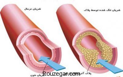 آترواسکلروز عروقی،آترواسکلروز شریان کرونر،آترواسکلروز در کودکان