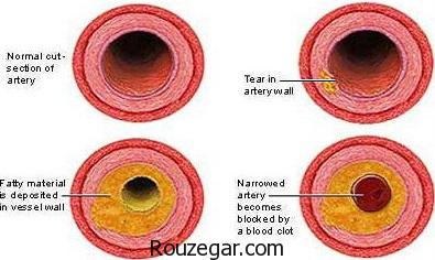 آترواسکلروز عروقی،آترواسکلروز شریان کرونر،آترواسکلروز در کودکان
