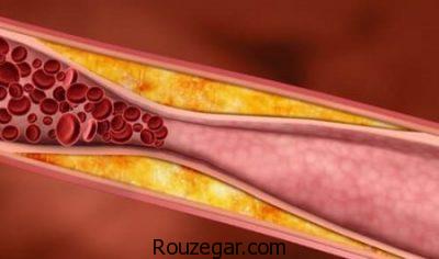 آترواسکلروز عروقی،آترواسکلروز شریان کرونر،آترواسکلروز در کودکان
