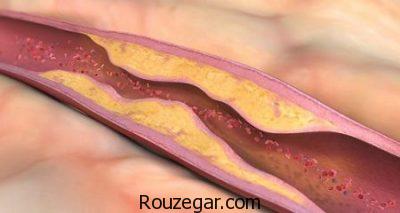 آترواسکلروز عروقی،آترواسکلروز شریان کرونر،آترواسکلروز در کودکان