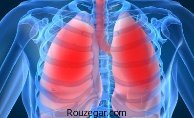 رژیم غذایی آمبولی ریه،عوارض آمبولی ریه،داروی گیاهی برای آمبولی ریه