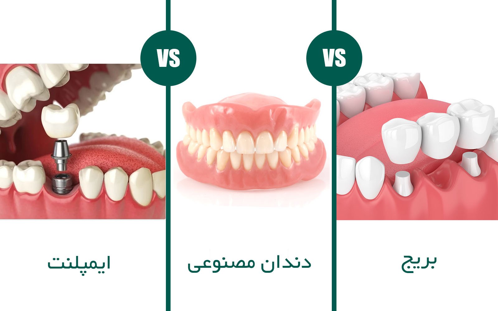 انواع کاشت دندان