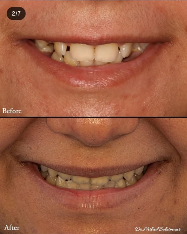 عکس قبل و بعد ارتودنسی دندان نهفته دکتر سلیمانی متخصص ارتودنسی در کرج