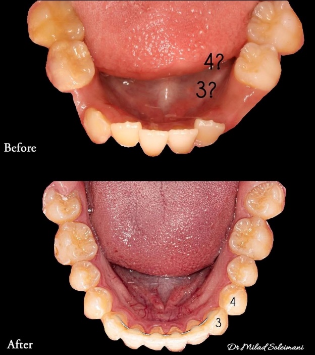 عکس سه بعدی دیجیتال دندان نهفته قبل و بعد