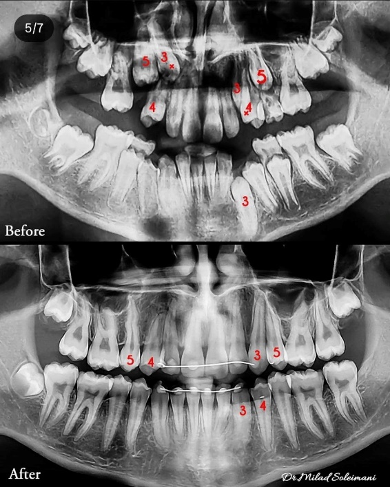 عکس رادیولوژی دندان نهفته رشد نامرتب دندان قبل و بعد